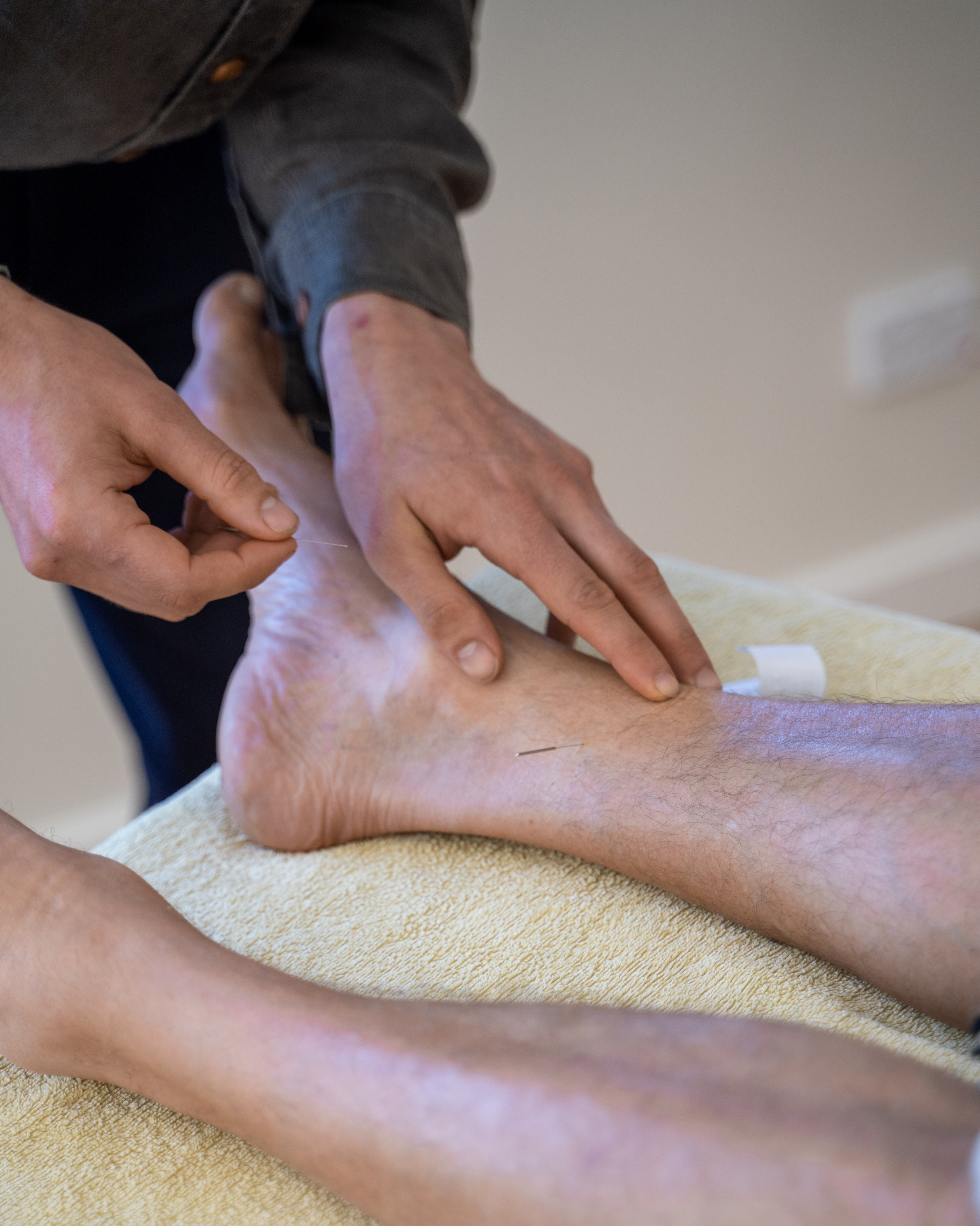 Acupuncture needle